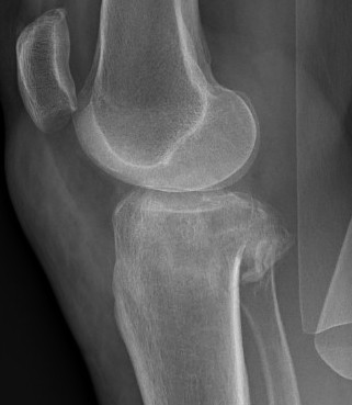 Posterolateral Tibial Plateau